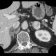 Collision tumour, adrenal gland, myelolipoma, metastasis: CT - Computed tomography